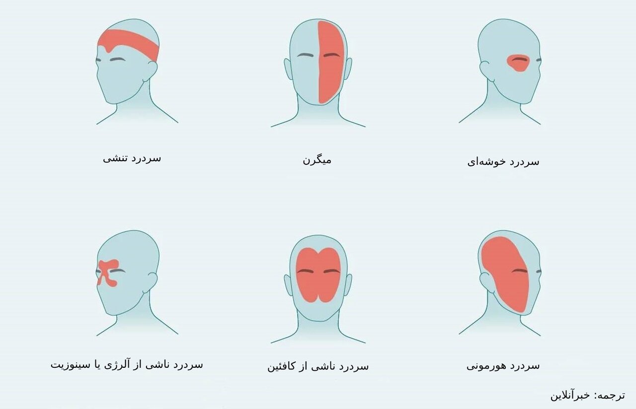علت درد در نواحی مختلف سر/ از سردرد خوشهای تا سردرد رعد و برقی+ تصاویر 6208515