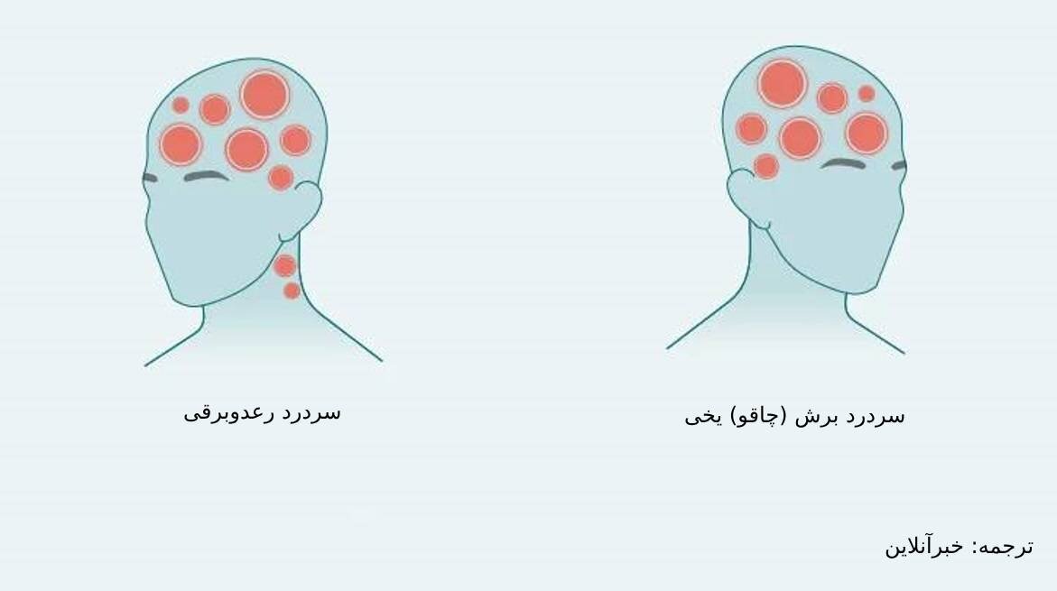 علت درد در نواحی مختلف سر/ از سردرد خوشهای تا سردرد رعد و برقی+ تصاویر 6208517